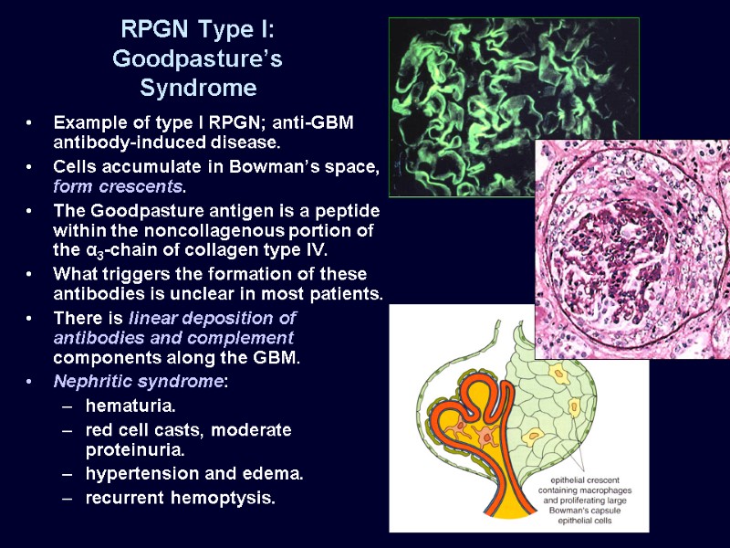 RPGN Type I: Goodpasture’s Syndrome Example of type I RPGN; anti-GBM antibody-induced disease. Cells